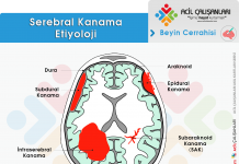 Hemorajik İnme (Stroke) Acil Yaklaşım