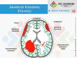 Hemorajik İnme (Stroke) Acil Yaklaşım