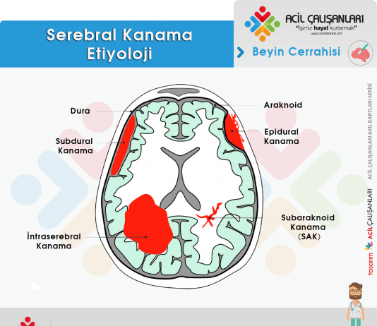 Hemorajik İnme (Stroke) Acil Yaklaşım