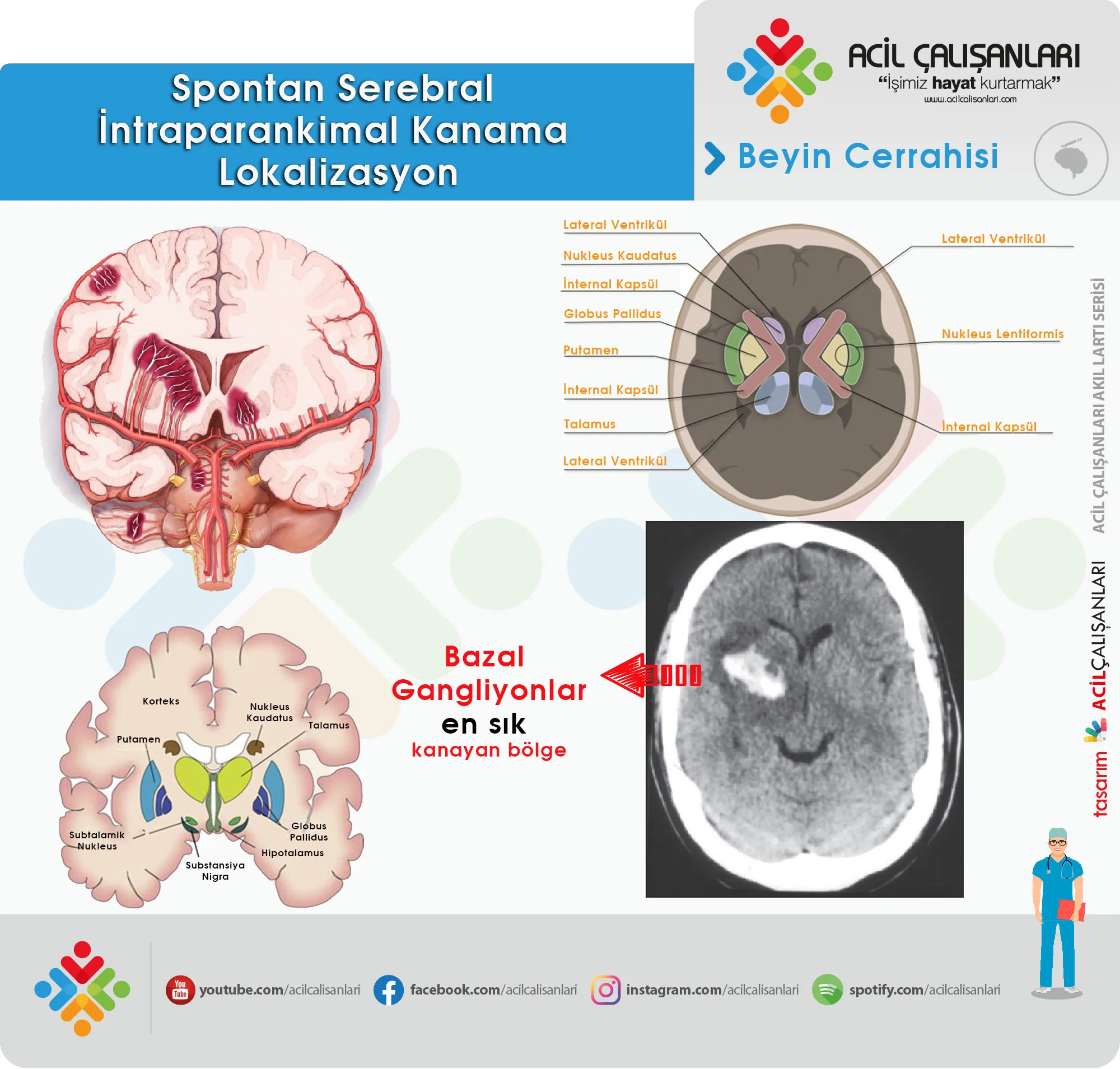 Spontan Serebral İntraparankimal Kanama Lokalizasyon