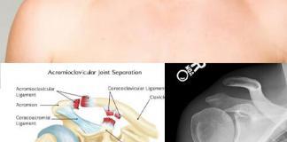 Akromiyoklaviküler Eklem Yaralanmaları