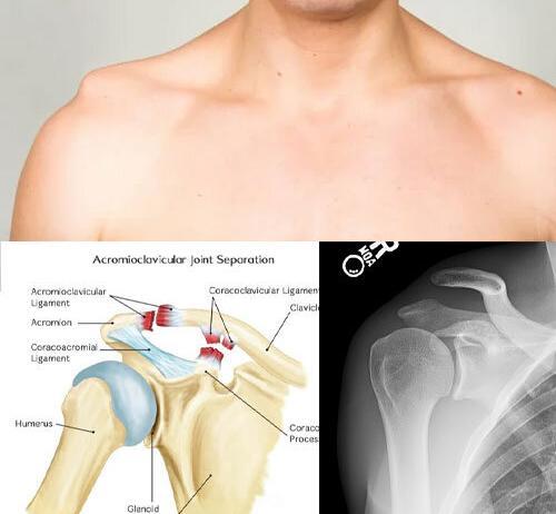 Akromiyoklaviküler Eklem Yaralanmaları