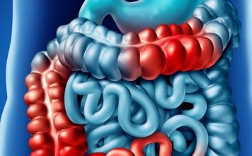 İleus Genel Yaklaşım