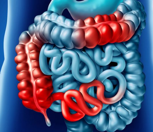 İleus Genel Yaklaşım