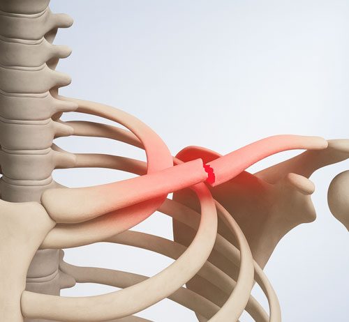 Klavikula Kırığı