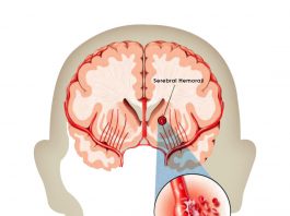 Spontan İntraserebral Kanama