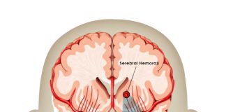 Spontan İntraserebral Kanama