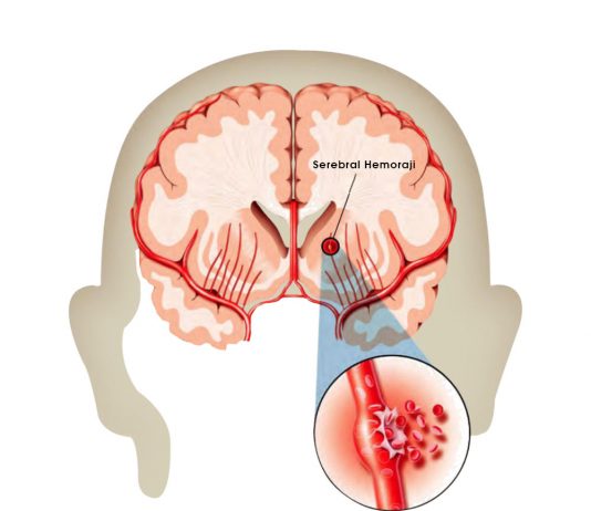 Spontan İntraserebral Kanama