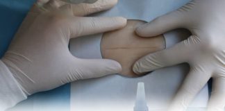 Doku Yapıştırıcısı Kullanılması