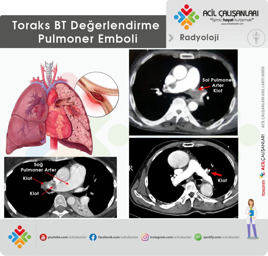 Acilde Toraks BT Değerlendirilmesi Acil Çalışanları