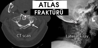 Atlas (C1) Kırıkları (Jefferson)