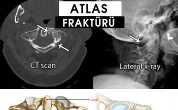Atlas (C1) Kırıkları (Jefferson)