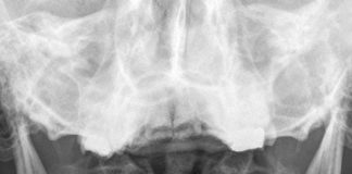 Odontoid (C2 Dens) Fraktürü