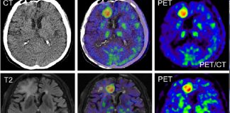 Acil Serviste Nöroradyolojik Görüntüleme