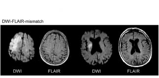 Difüzyon MR Yorumlanması