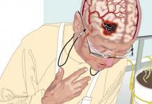 İskemik İnme (Stroke) Acil Yaklaşım