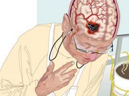 İskemik İnme (Stroke) Acil Yaklaşım