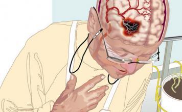 İskemik İnme (Stroke) Acil Yaklaşım