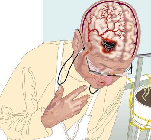 İskemik İnme (Stroke) Acil Yaklaşım