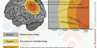 İskemik Stroke Penumbra Akıl Kartı