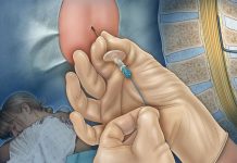 Lomber Ponksiyon (LP)