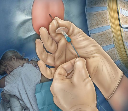 Lomber Ponksiyon (LP)