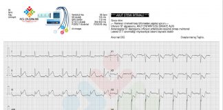 Akut İnferoposterior Miyokard İnfarktüsü Olgu Sunumu