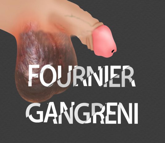 Fournier Gangreni
