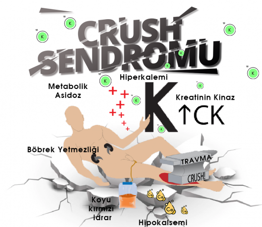 Crush Sendromu Acil Yaklaşım
