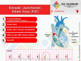Prematüre Kavşak (Junctional) Atım (PJC)
