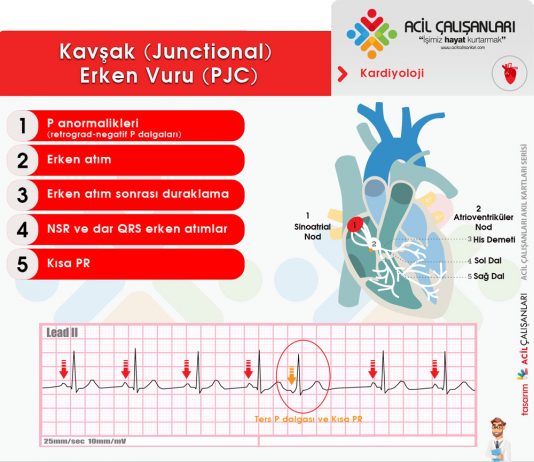 Prematüre Kavşak (Junctional) Atım (PJC)