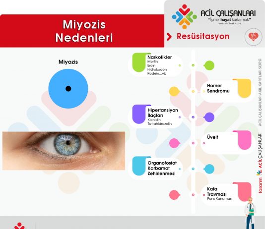 Miyozis Nedenleri Akıl Kartı