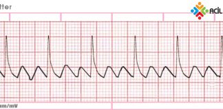 Atrial Flutter