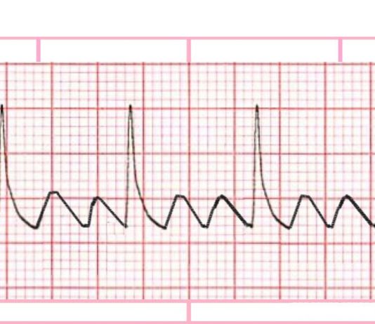 Atrial Flutter