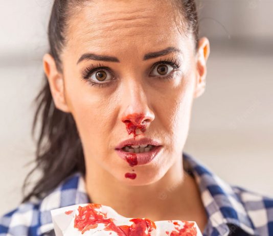 Epistaksis (Burun Kanaması) Yönetimi