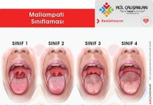 Mallampati Sınıflaması Akıl Kartı