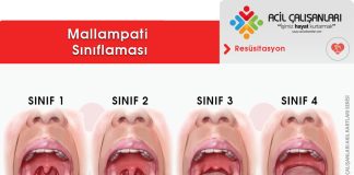 Mallampati Sınıflaması Akıl Kartı