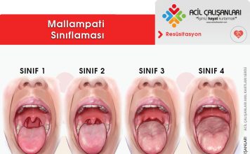 Mallampati Sınıflaması Akıl Kartı