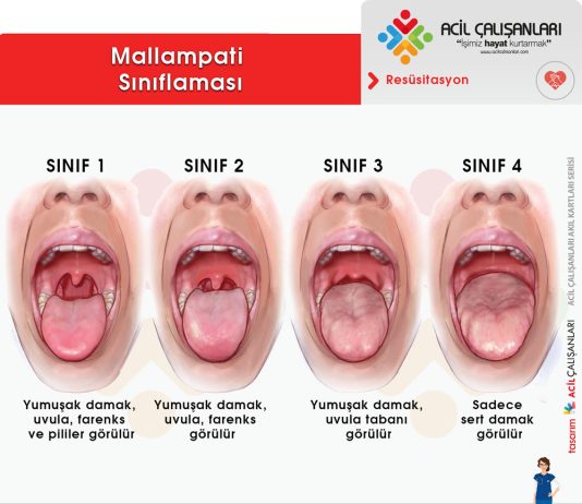 Mallampati Sınıflaması Akıl Kartı