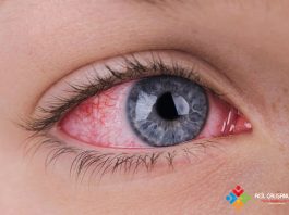 Kırmızı Göze Acil Yaklaşım