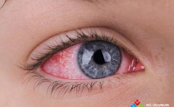 Kırmızı Göze Acil Yaklaşım