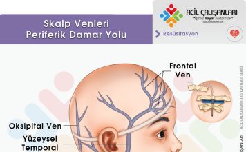 Kafa Derisi Ven Kateterizasyonu