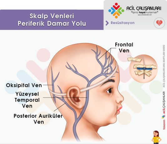 Kafa Derisi Ven Kateterizasyonu