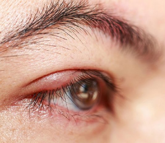 Blefarit Acil Yaklaşım