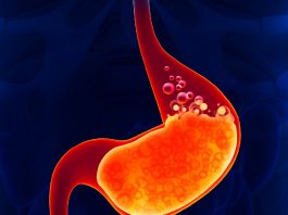 Gastrit Acil Yaklaşım