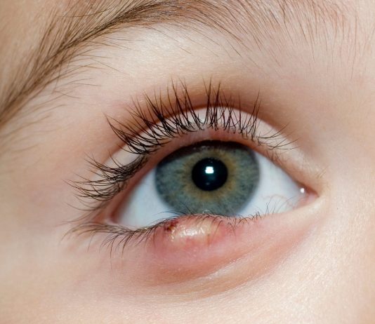 Hordeolum (Arpacık) Acil Yaklaşım