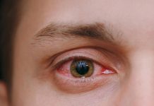 Konjonktivit Acil Yaklaşım