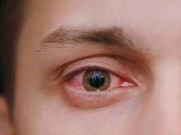 Konjonktivit Acil Yaklaşım