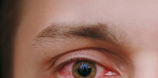 Konjonktivit Acil Yaklaşım