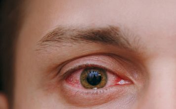 Konjonktivit Acil Yaklaşım